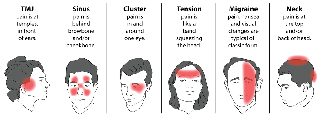 cervicogenic-headaches-asiya